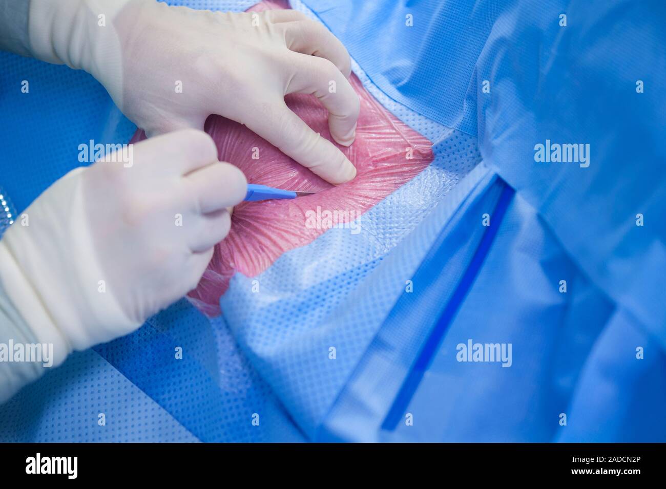 Implantable defibrillator surgery. Closeup of a surgeon making the