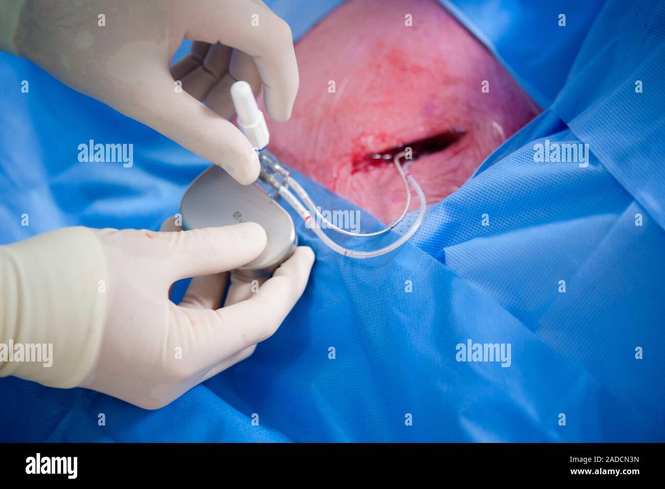Implantable defibrillator surgery. Closeup of a surgeon connecting