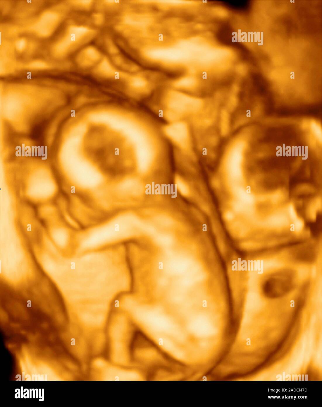 3D ultrasound scan of triplet foetuses at 15 weeks. Nonidentical