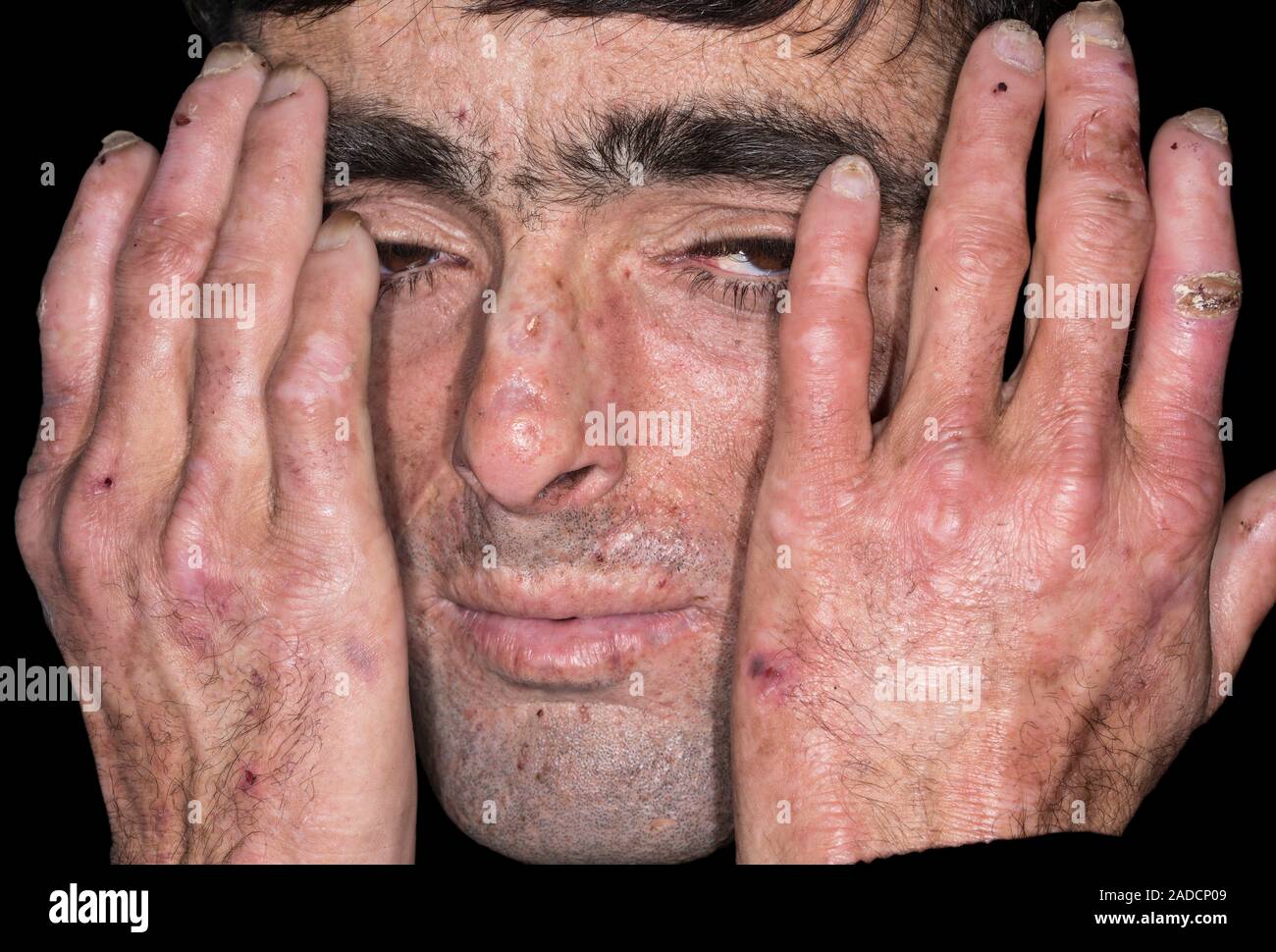 Hands and face of a male patient with porphyria cutanea tarda (PCT), a type of cutaneous porphyria. Porphyria is the name given to a group of disorder Stock Photo