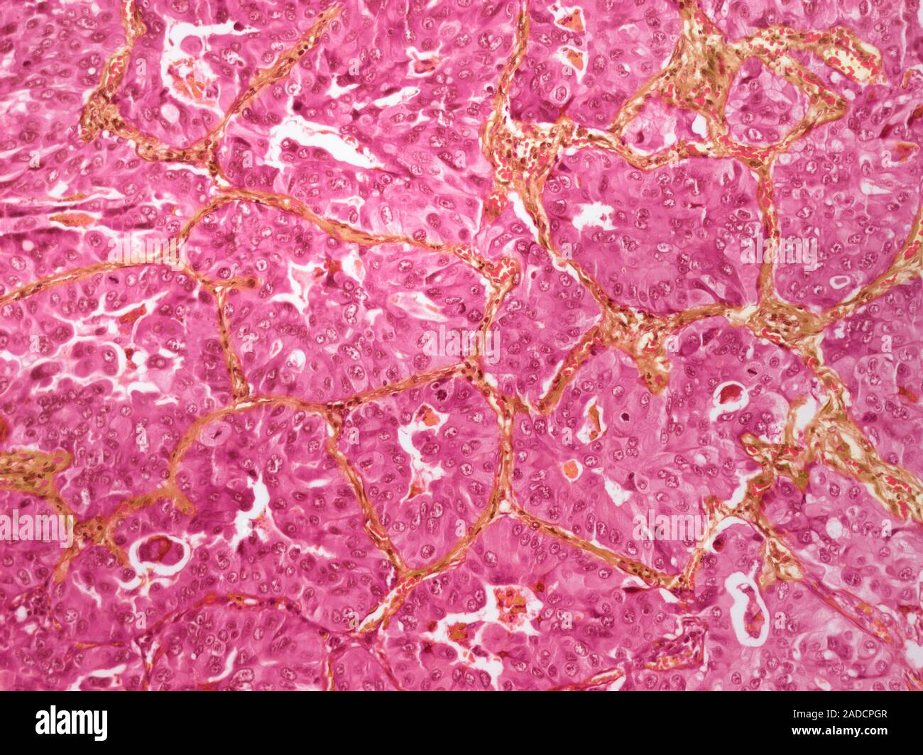 Adenocarcinoma. Light Micrograph (lm) Of An Adenocarcinoma Of The Lung 