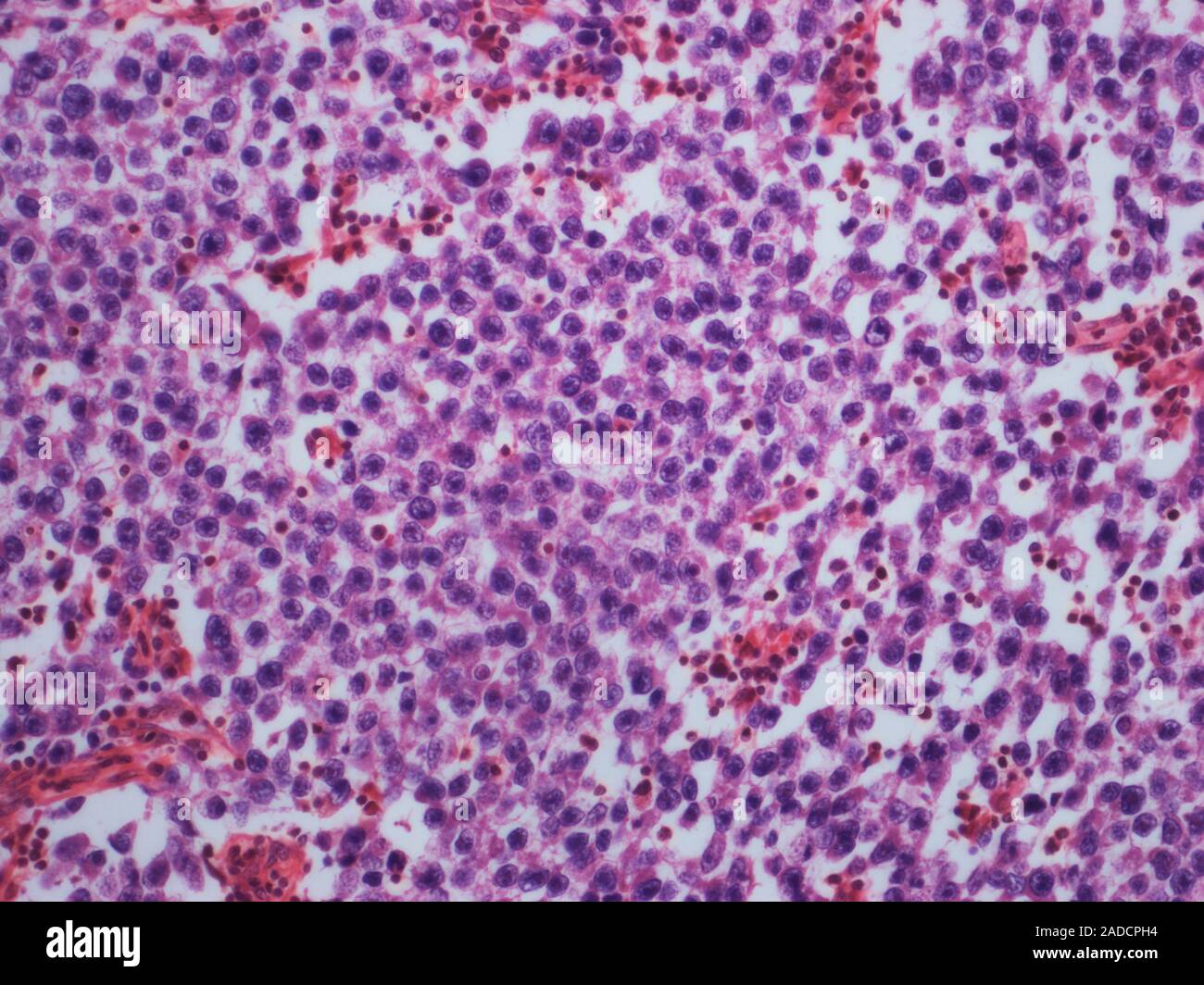 Testicular Cancer Light Micrograph Lm Of A Section Through A