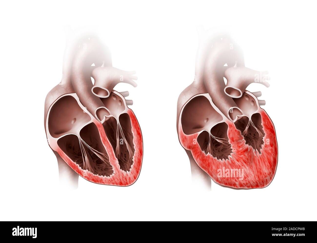 Normal and enlarged hearts. Cutaway illustrations of a normal (left ...