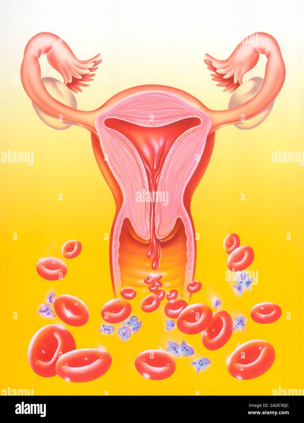 Heavy bleeding in menstruation. Illustration of a uterus (upper centre