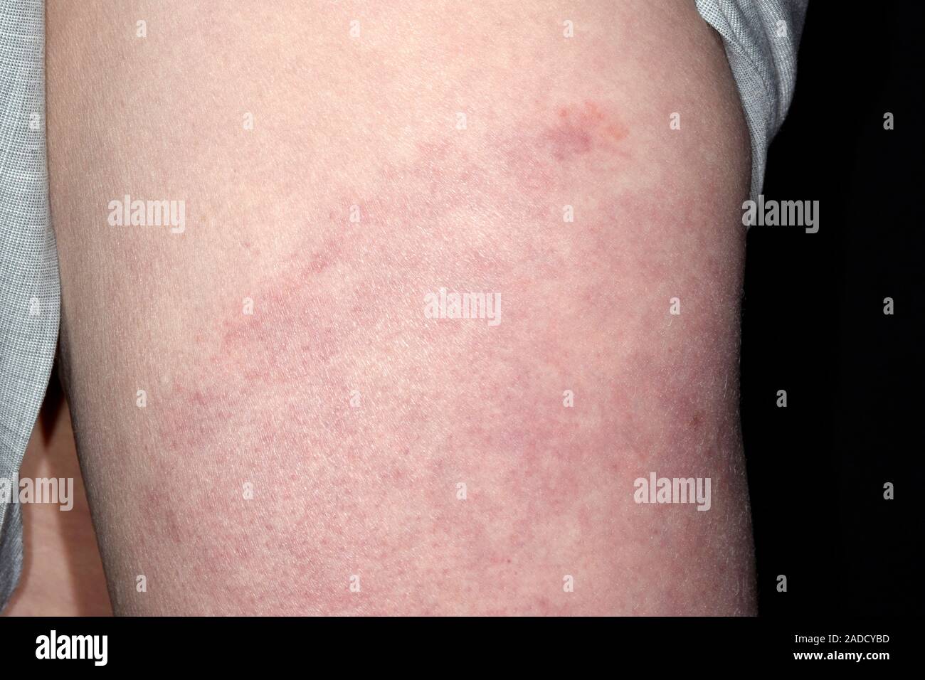 Rash in Lyme's disease in a 59yearold woman. Lyme disease is caused