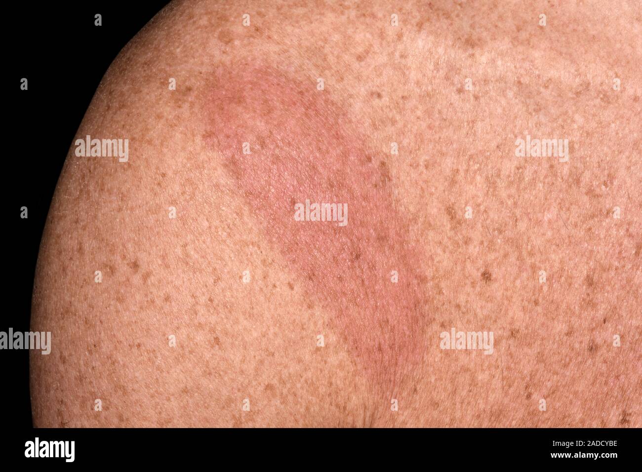 Rash in Lyme's disease on a 58yearold man's shoulder. Lyme disease is