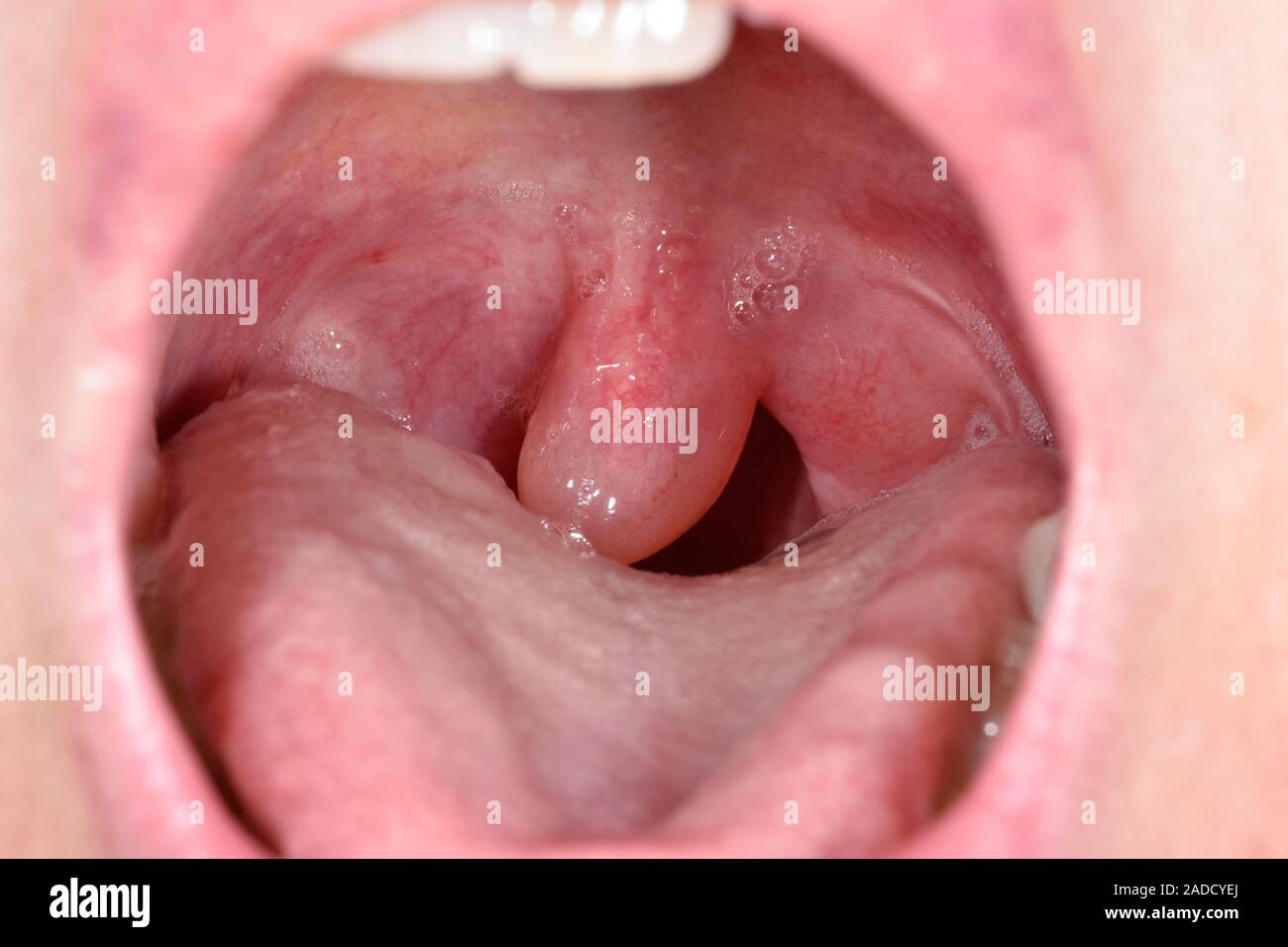 Abnormal Uvula
