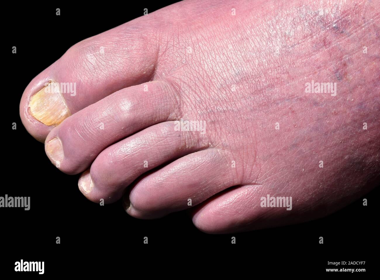 Poor blood supply in peripheral vascular disease. Blue foot affecting