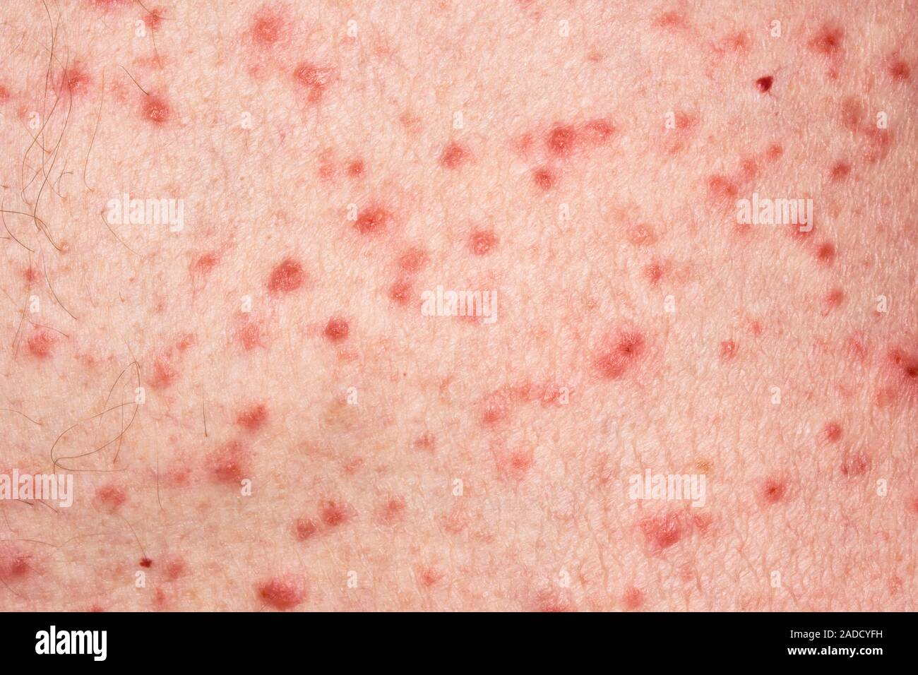Grover's disease affecting the skin of a 78-year-old man. Grover's ...