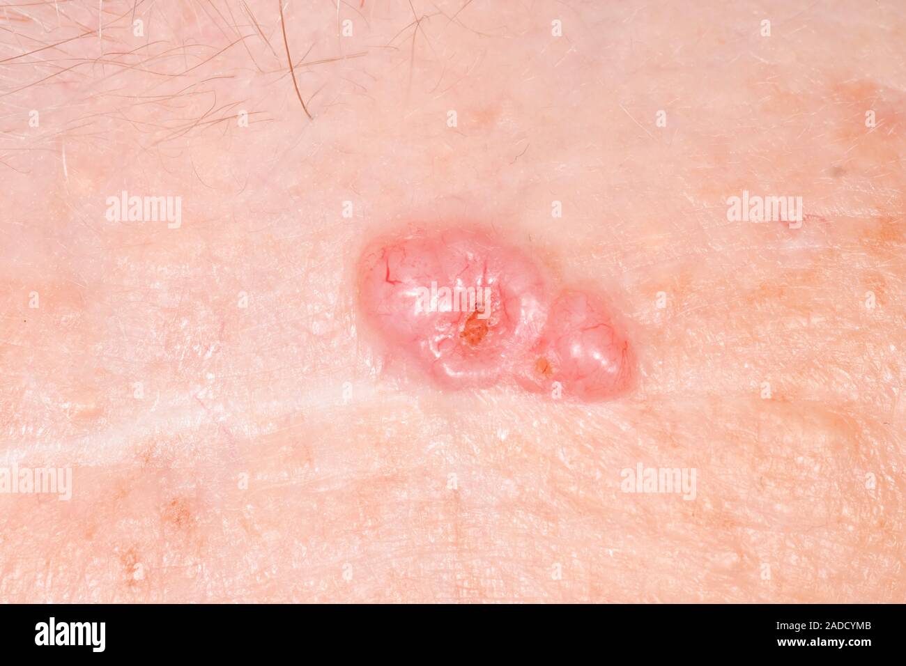 Basal cell carcinoma on the forehead of an 87yearold woman. Basal