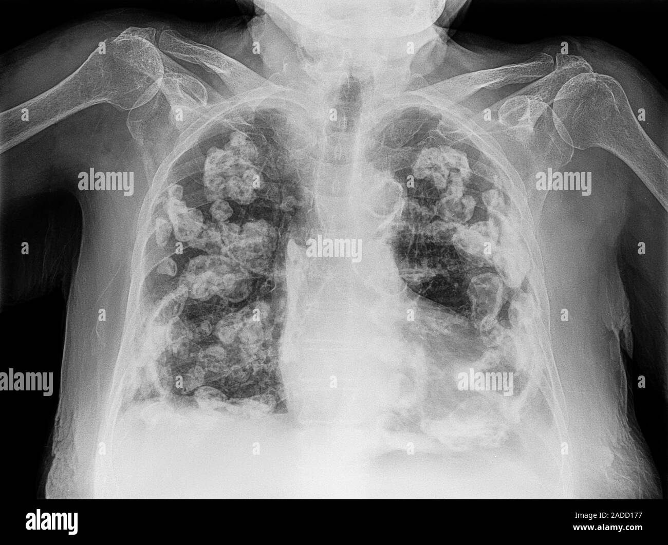 Bilateral pleural calcification, X-ray. The pleura are the membranes ...