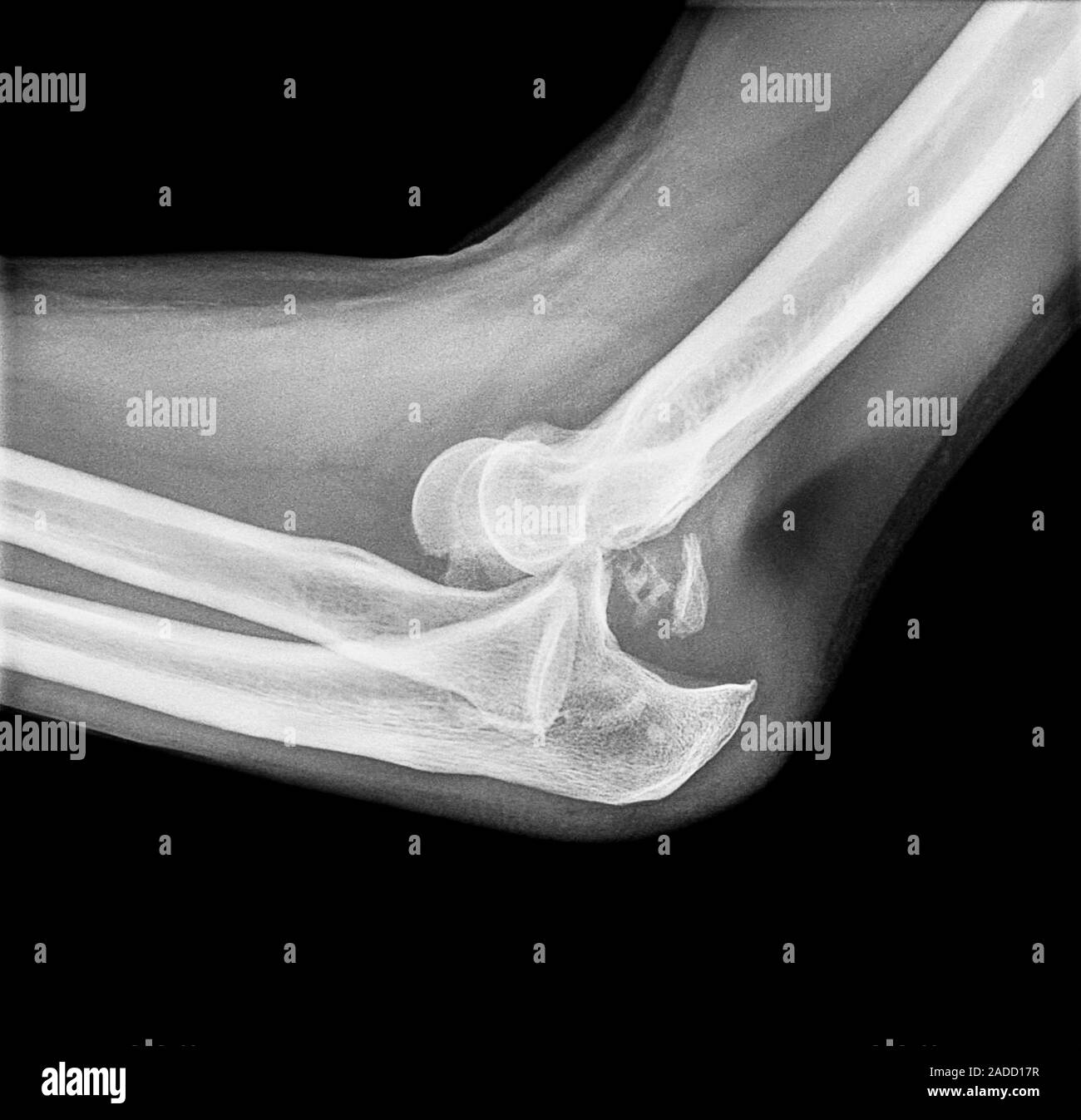 Dislocated elbow. Xray of the elbow of a 58yearold man with a