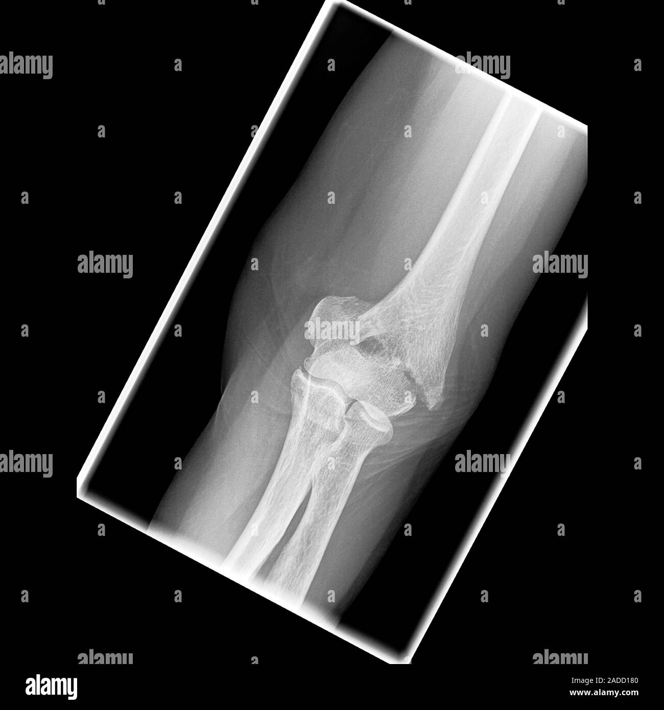 Elbow Fracture X Ray Of The Elbow Of A 75 Year Old Woman With An Elbow Effusion Fluid On The 6556