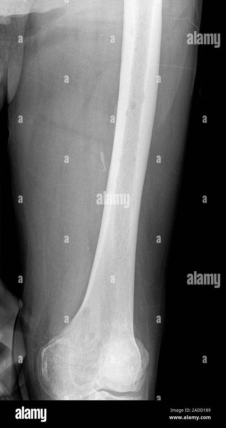Myeloma bone scan, X-ray. Multiple myeloma is a cancer of plasma white ...