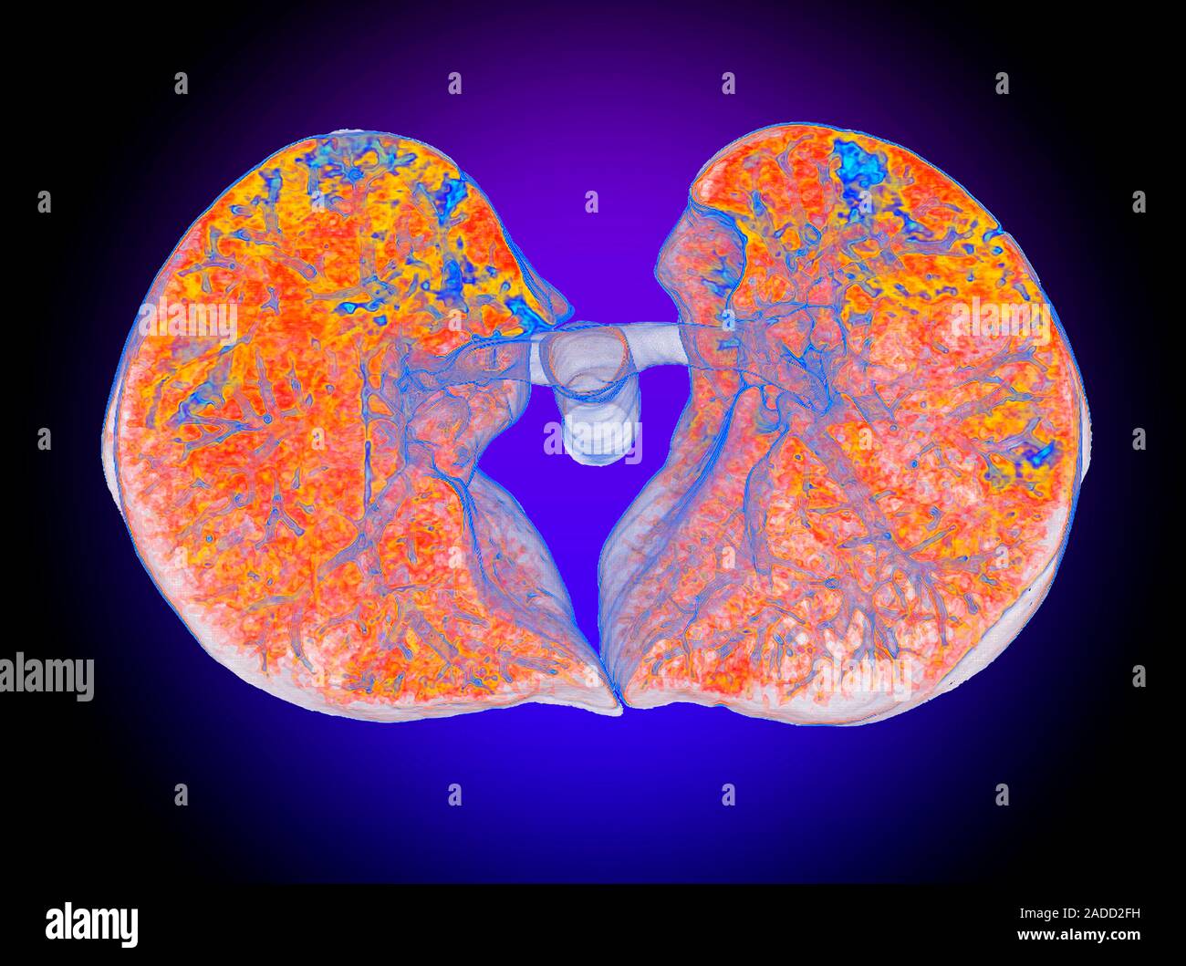 SARSCoV lung damage. Coloured 3D computed tomography (CT) scan of the