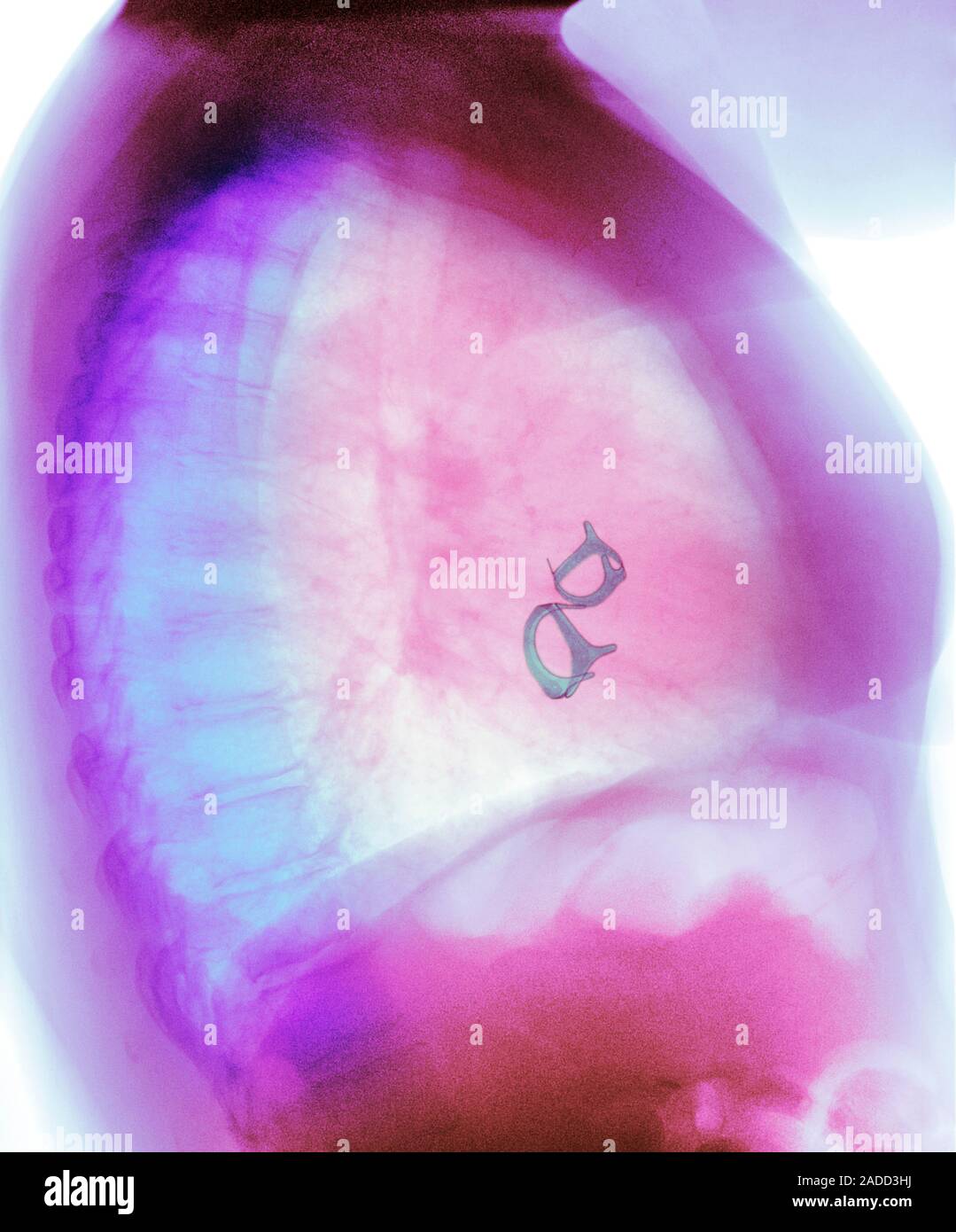 Mitral valve replacement. Postoperative coloured Xray of a lateral