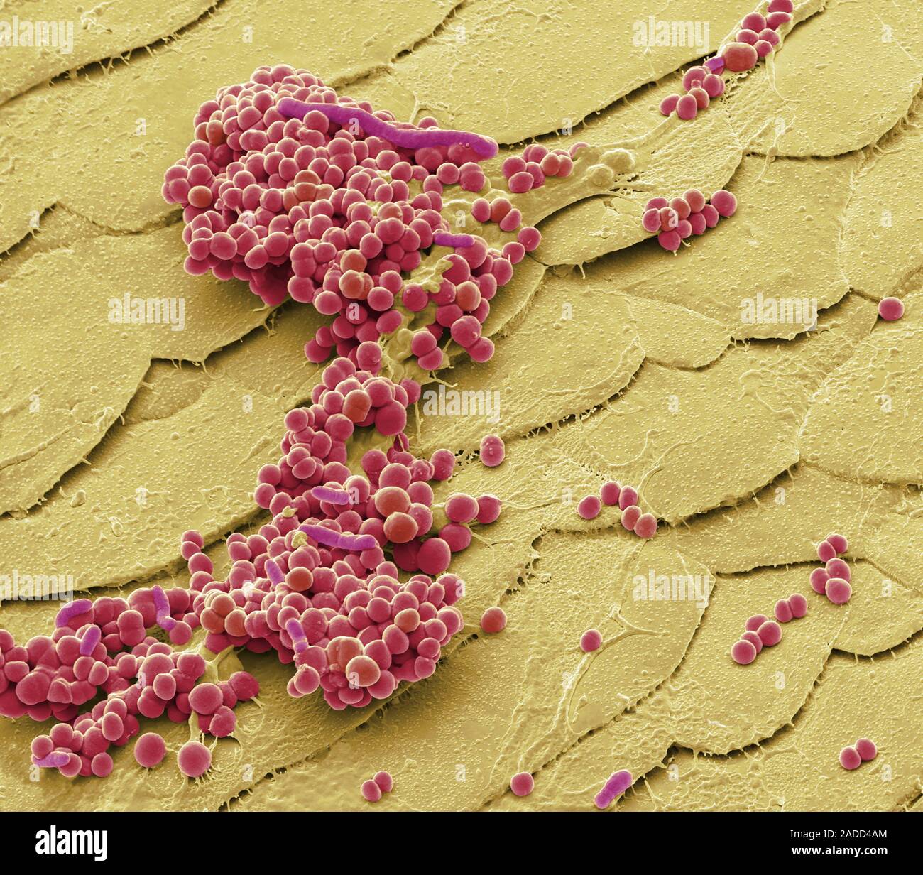 Folliculitis. Coloured scanning electron micrograph (SEM) of bacteria