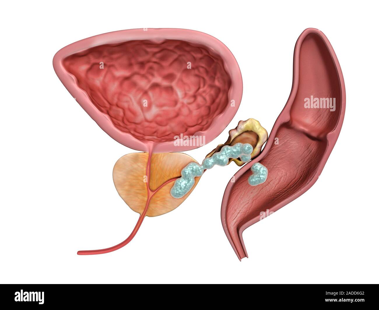 Stage IV prostate cancer. Illustration of part of the male reproductive