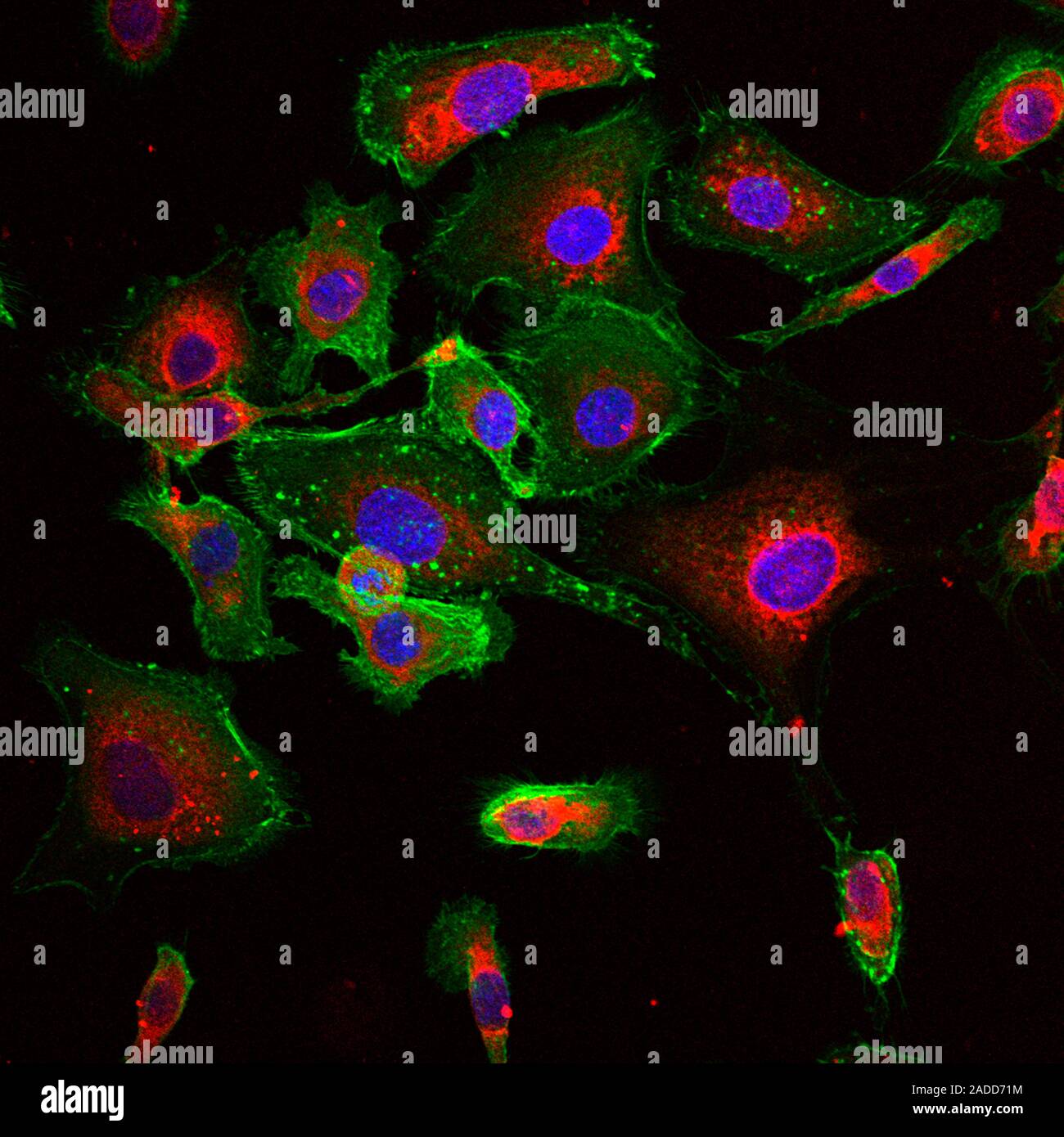 RNA nanoparticles in cancer cells. Fluorescent light micrograph of RNA ...