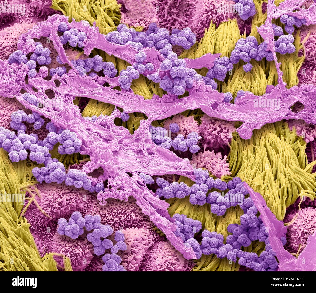 Phlegm in the airway. Scanning electron micrograph (SEM) composition of ...