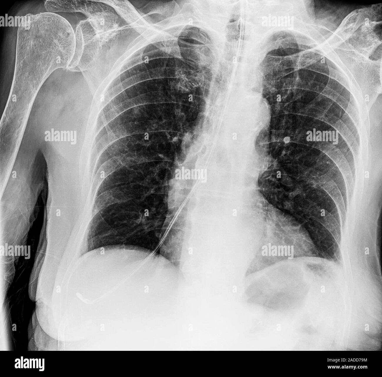 Incorrectly positioned nasogastric tube, X-ray. Nasogastric tubes are ...