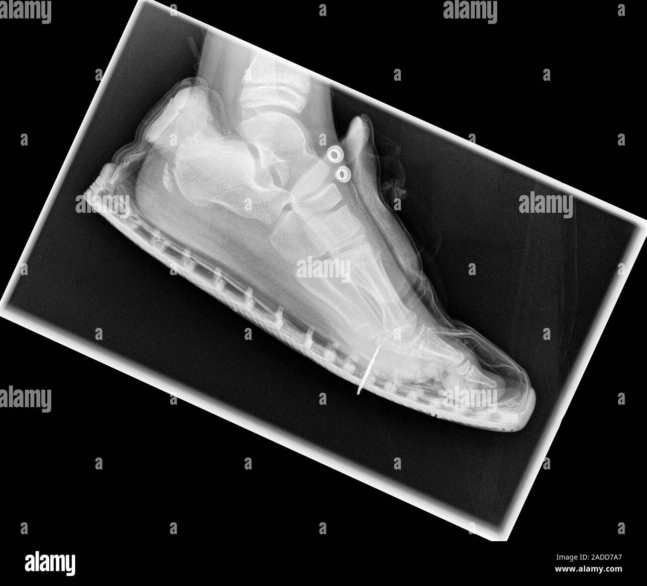 Nail injury to foot, Xray. The patient stepped on a nail (white, lower