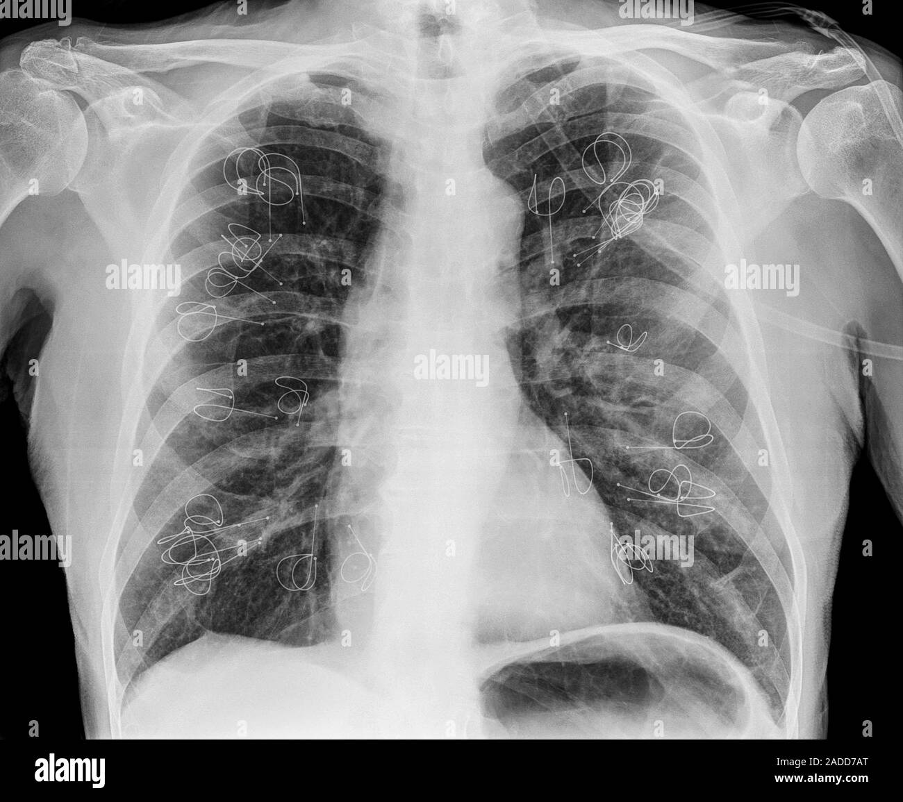 Implanted lung volume reduction coils. Xray of the lungs of a patient
