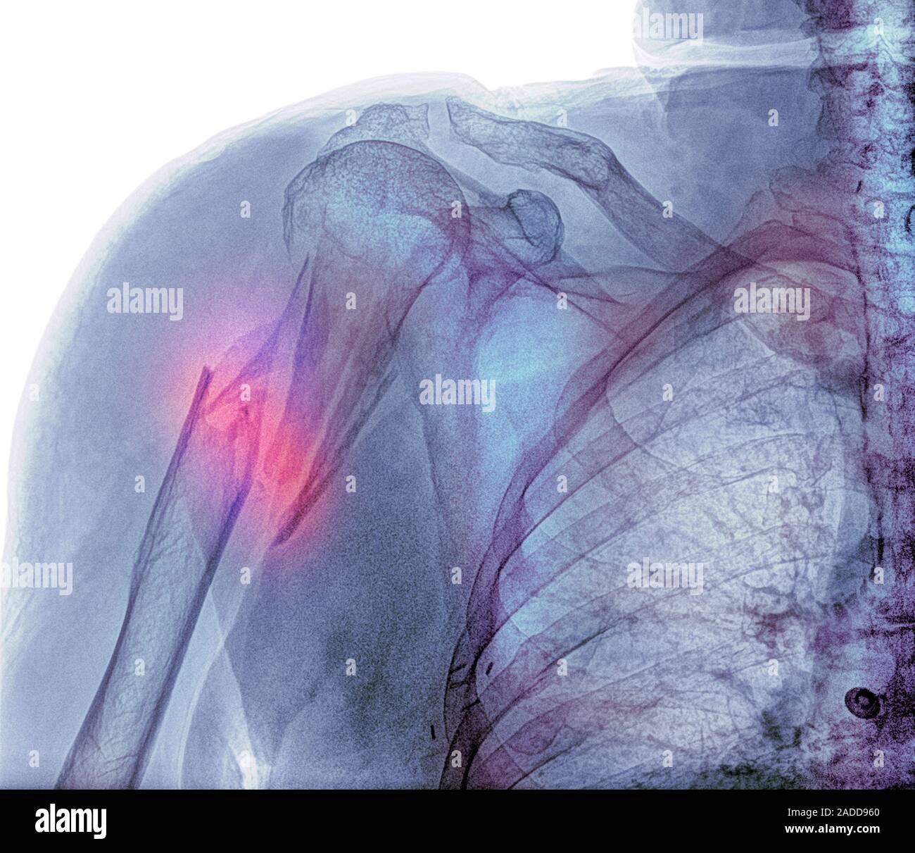 Broken upper arm bone. Coloured frontal Xray of the fractured right