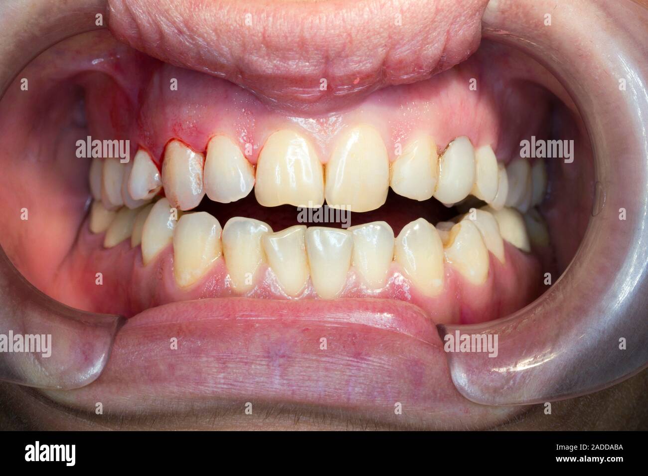 Open bite. Closeup of the mouth of a patient with an open bite. Open