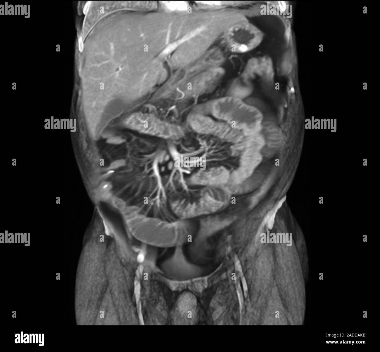 Crohn's disease research. Coronal magnetic resonance imaging (MRI) scan ...
