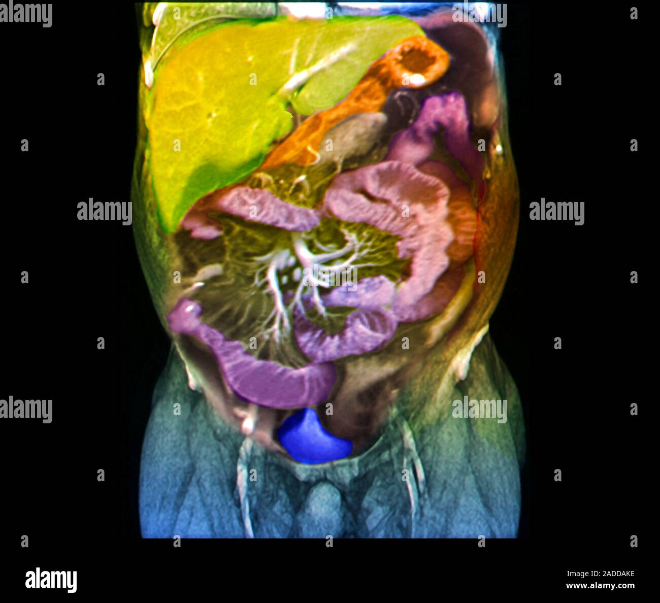 Crohn's disease research. Coloured coronal resonance imaging