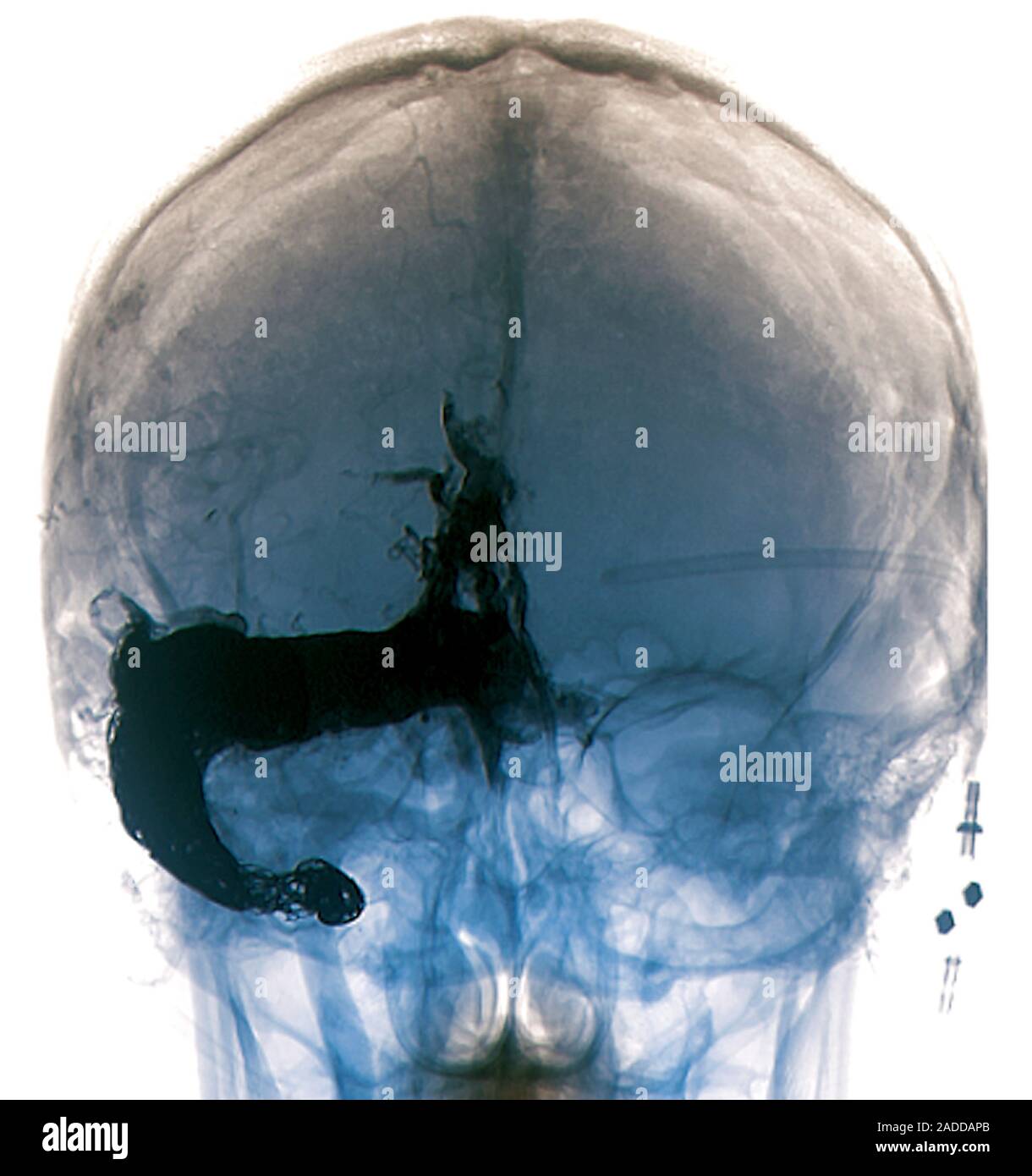 Cerebral arteriovenous malformation treatment. Frontal coloured Xray of the skull of a 32year