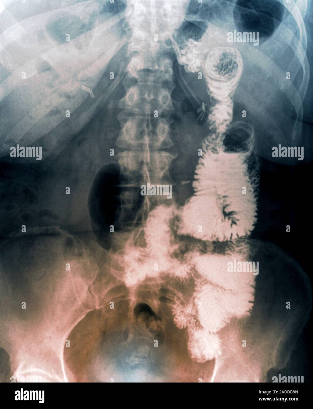 Gastric bypass. Coloured frontal X-ray of the digestive system of an ...