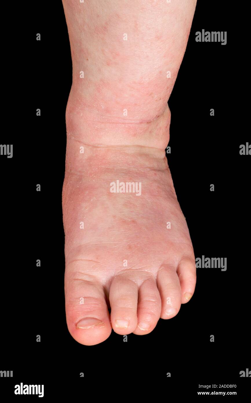 Atopic eczema on a baby's foot. Atopic eczema affecting areas of skin
