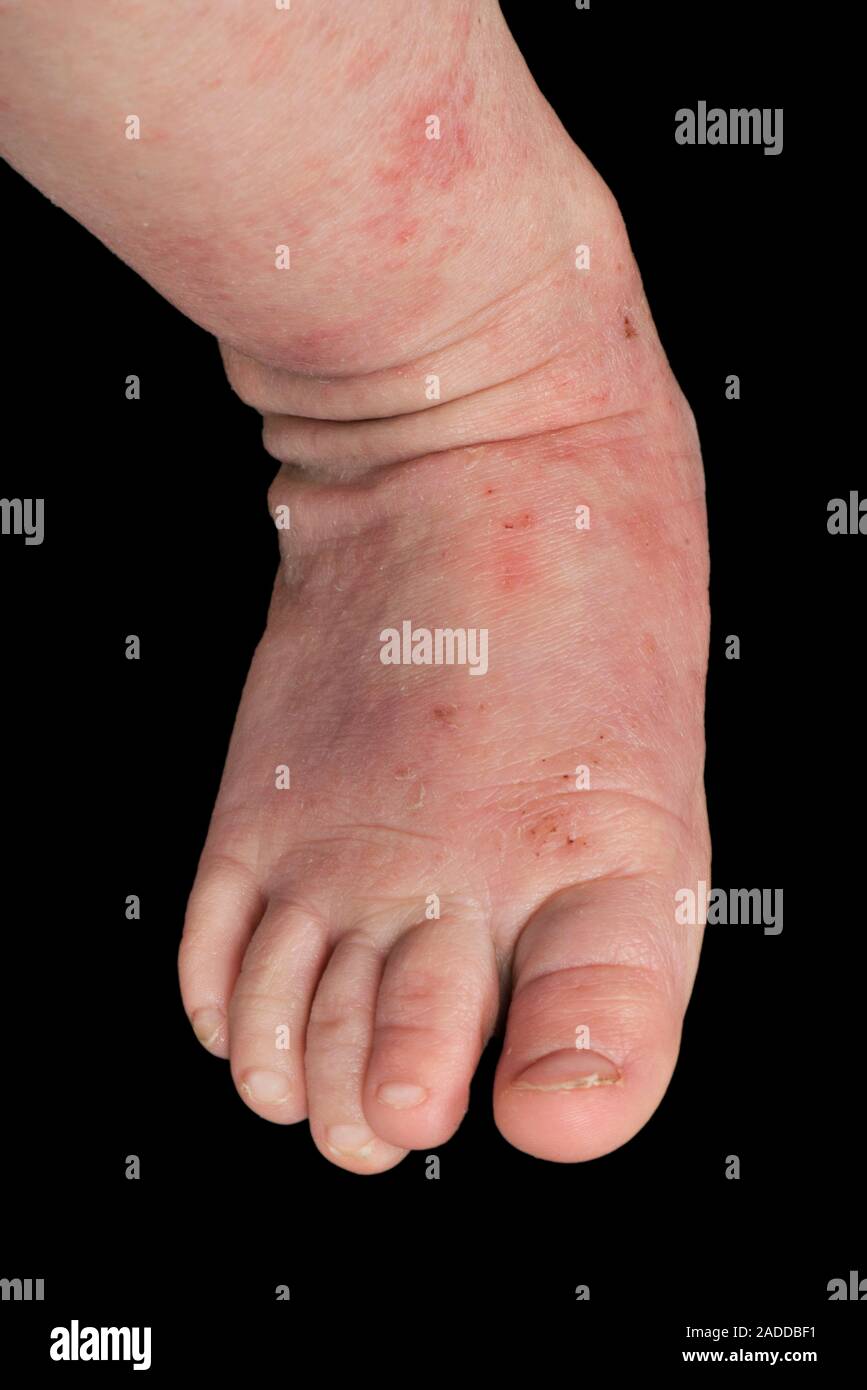 Atopic eczema on a baby's foot. Atopic eczema affecting areas of skin