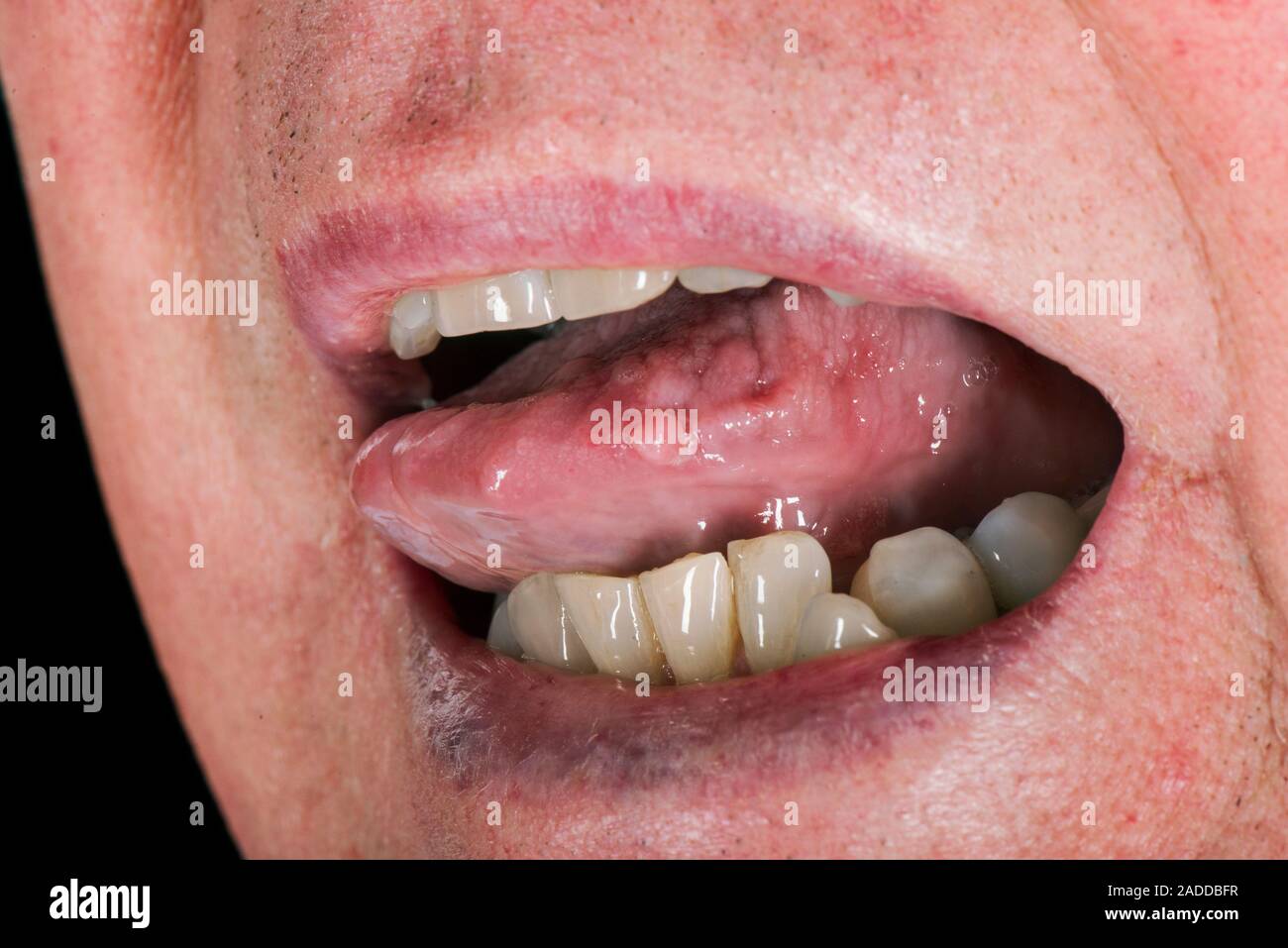 Tongue wart. Papilloma (wart) on the edge of the tongue of a 70-year-old man. This is a growth caused by the human papilloma virus (HPV). There are ov Stock Photo