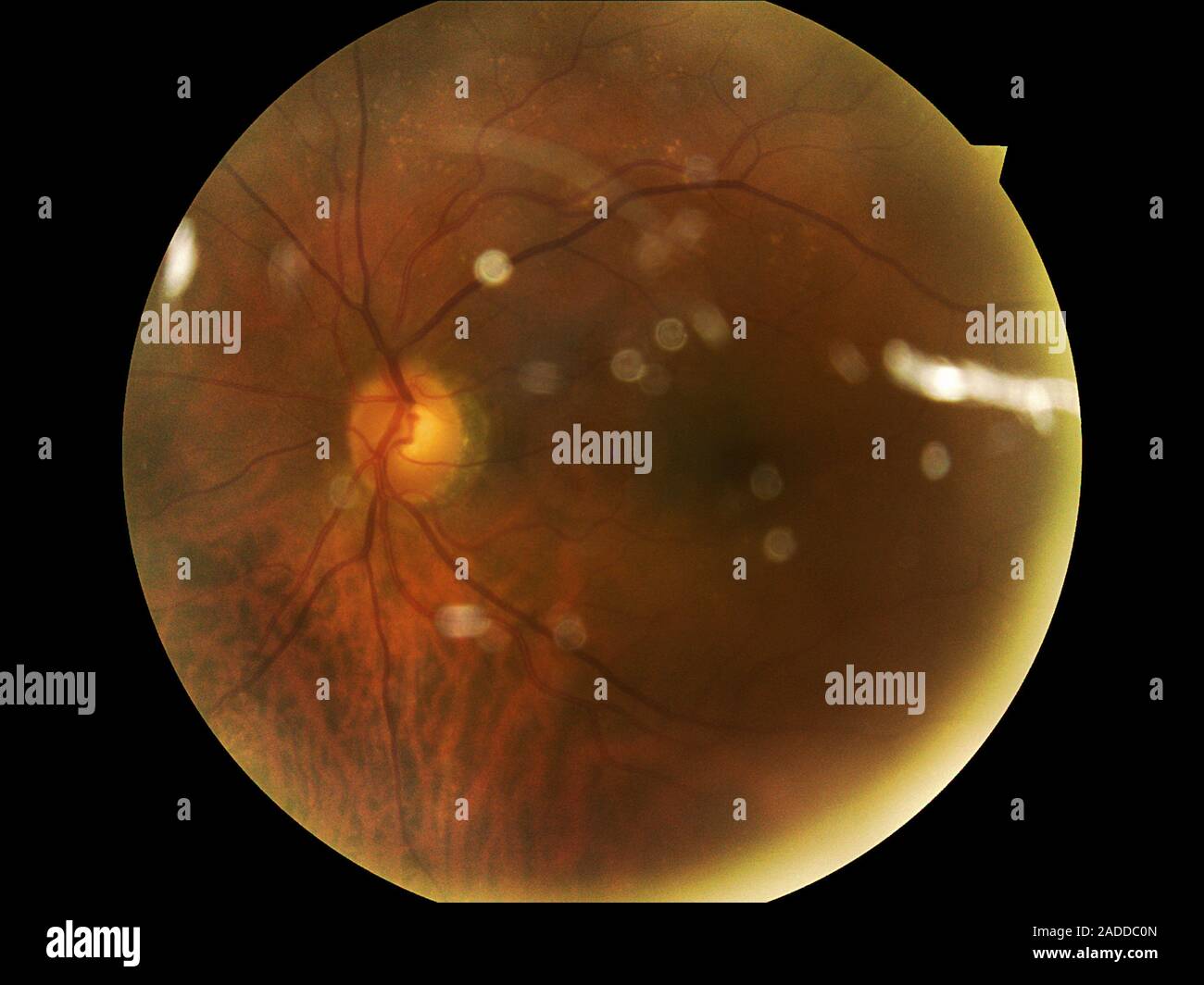 Agerelated macular degeneration (AMD). Fundoscopy image of the retina