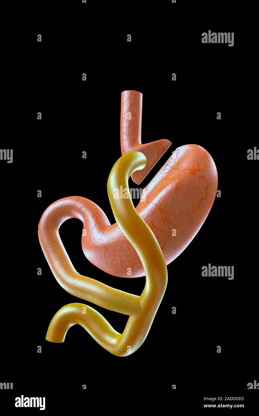 Gastric bypass. Computer illustration of a human stomach following