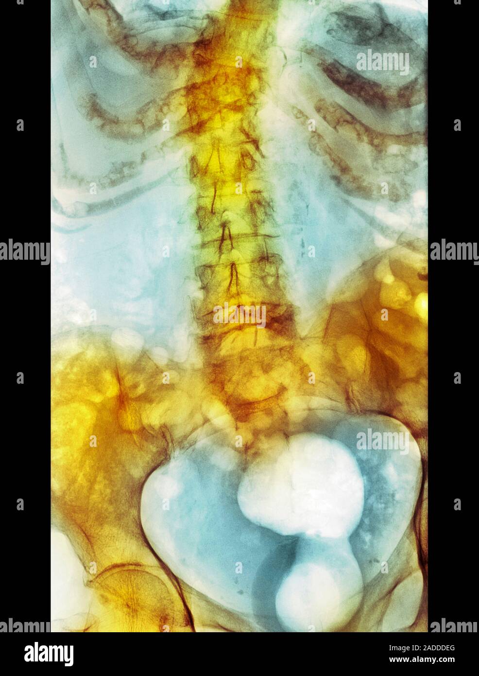 Spinal bone density reduction. Coloured Xray of a section through the