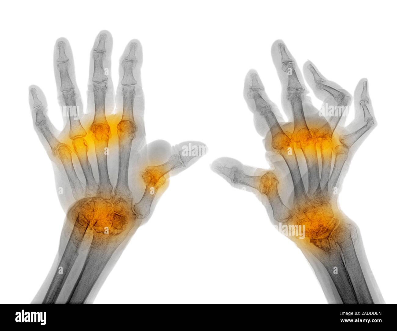 Rheumatoid arthritis of the hands. Coloured bilateral Xray of the