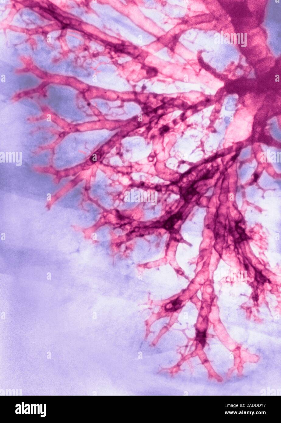 Coloured chest Xray of the lung of a patient with valley fever, or