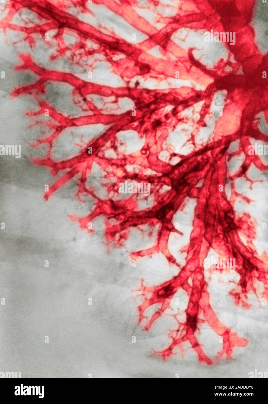 Coloured chest Xray of the lung of a patient with valley fever, or