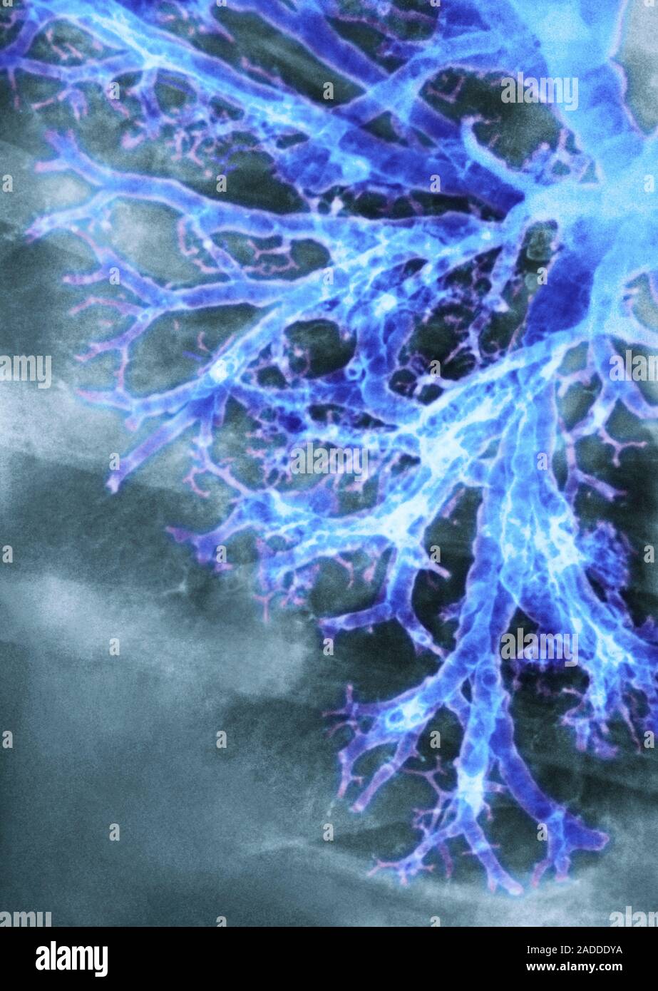 Coloured chest Xray of the lung of a patient with valley fever, or