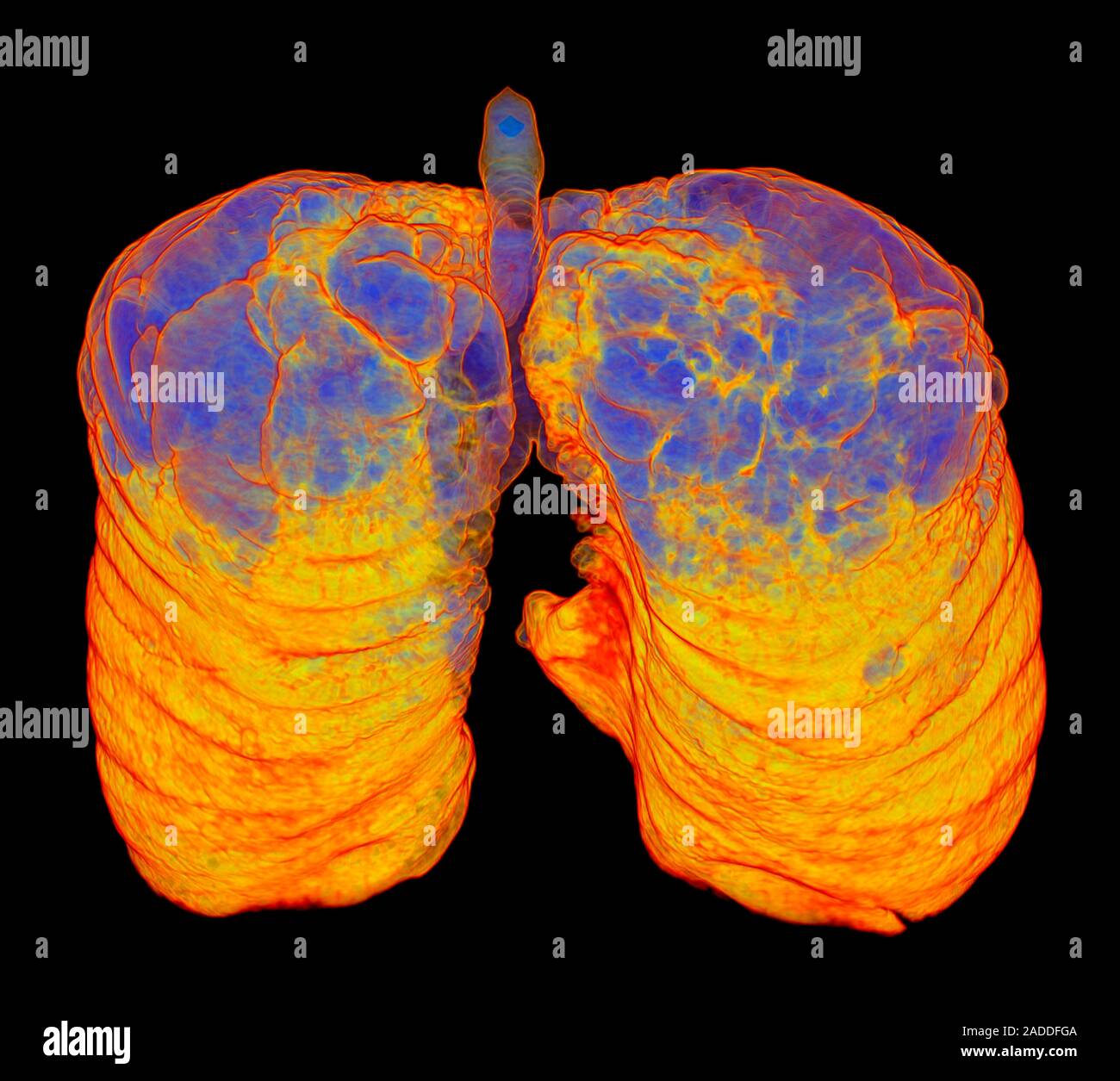 Smoker's lungs and emphysema. Coloured posterior 3D computed tomography