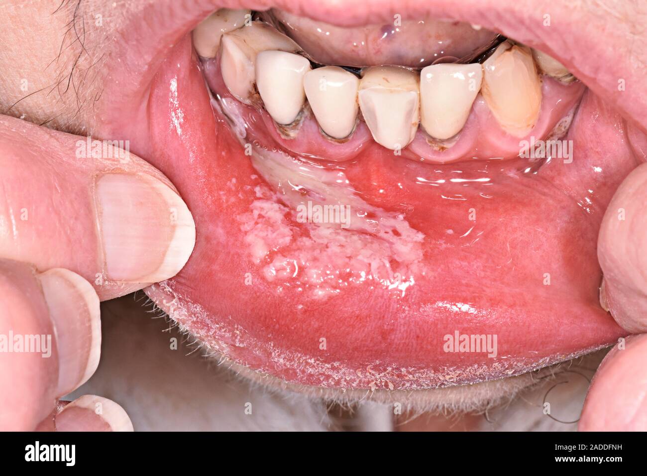 Oral thrush. Close up of the mouth of an 82 year old woman with a candidiasis infection white areas Candidiasis known as thrush is an infection b Stock Photo Alamy