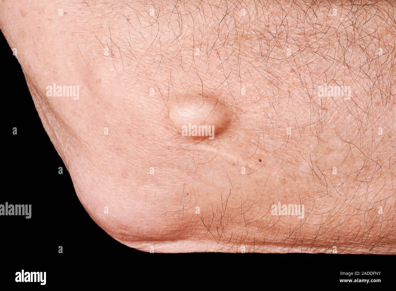 Ganglion (lump at centre) on a 70yearold man's elbow. This is a type