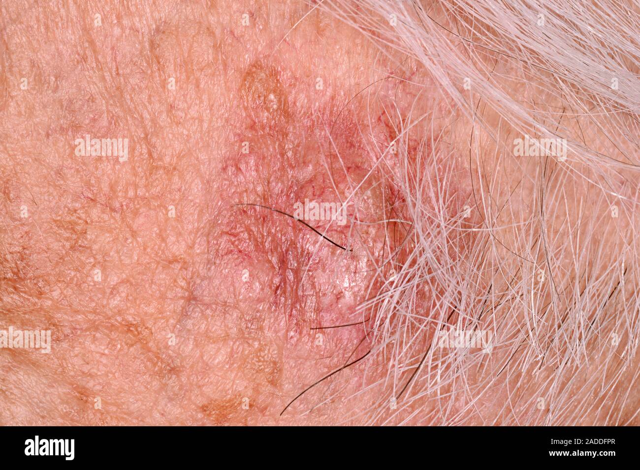Basal cell carcinoma on the temple of a 75yearold man. Basal cell