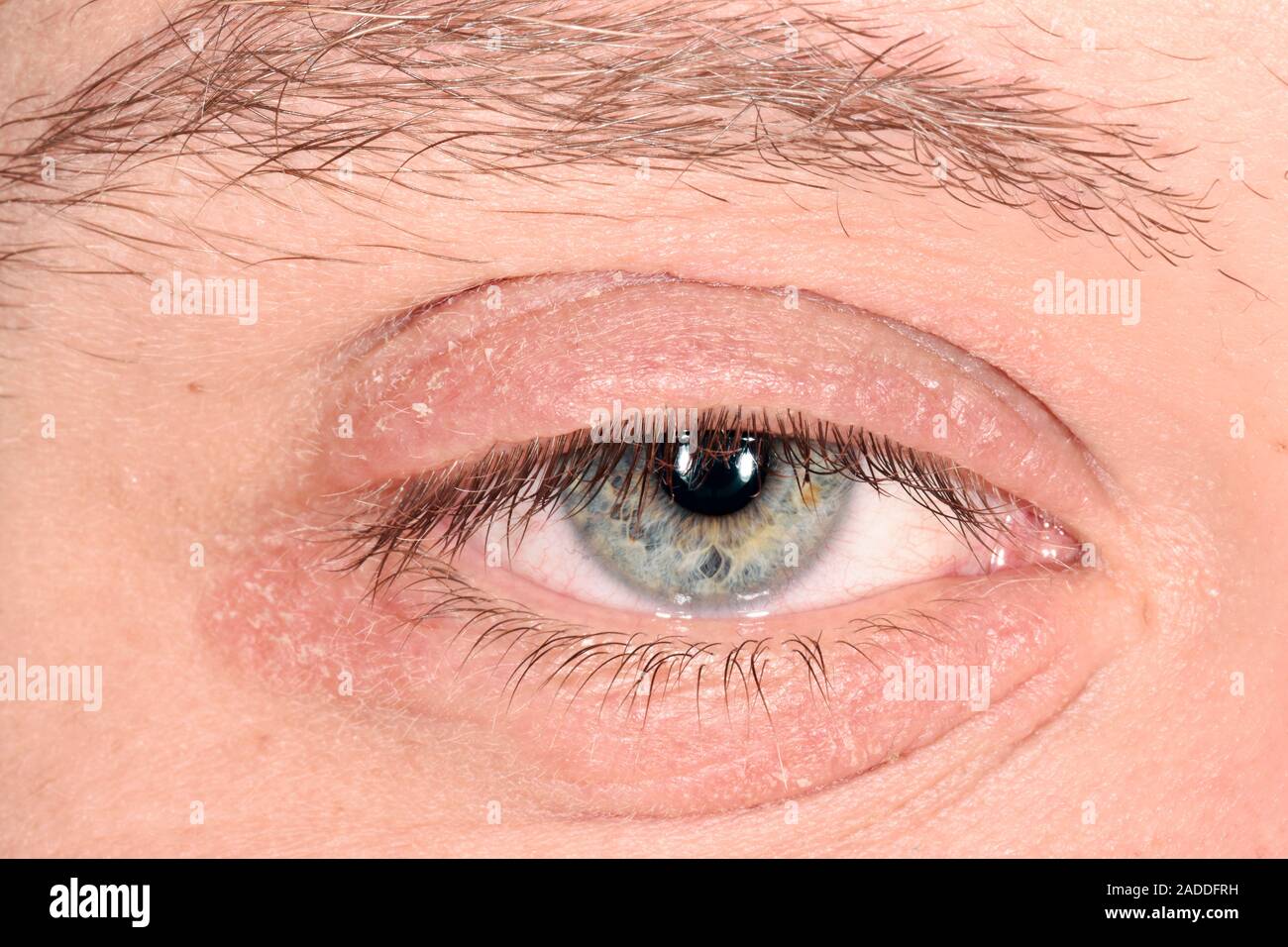 Periorbital dermatitis. Sore and inflamed skin around the eyes of a 25