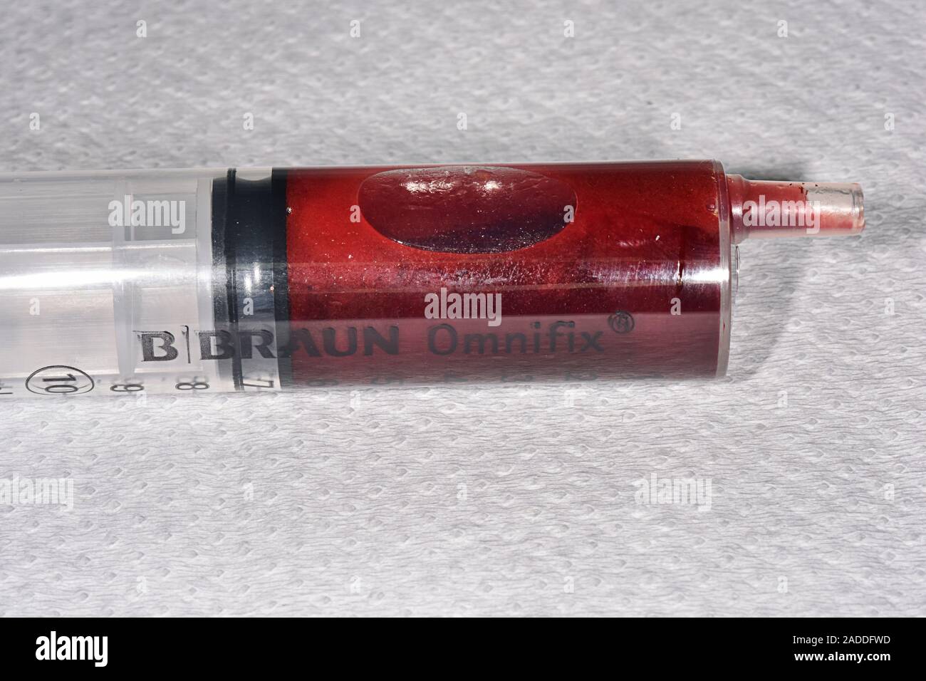 Blood and fluids removed from fractured knee joint in a 62yearold