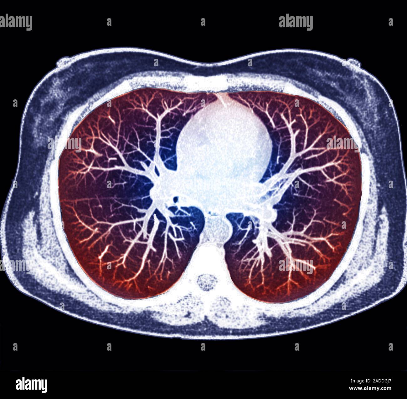 Heart and lungs. Axial computed tomography (CT) scan of the chest of a ...